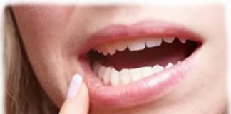 Воспаление полости рта — лечение воспаления полости рта